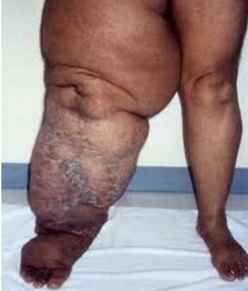 Courtesy of: www.lymphedemblog.com – Secondary Lymphedema